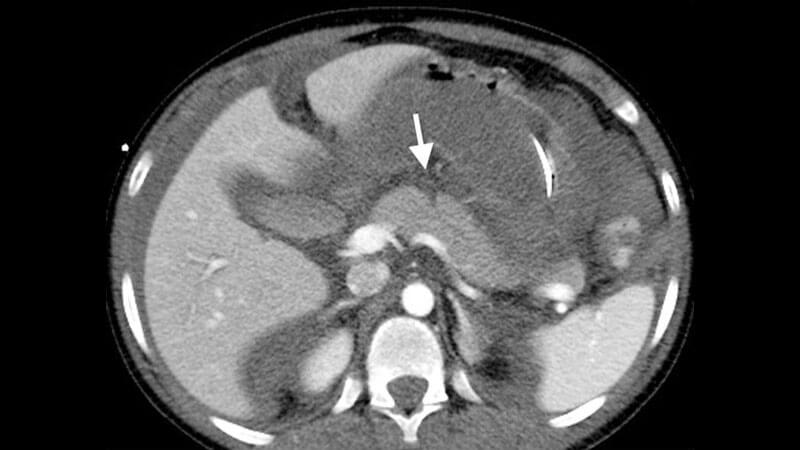 pancreatic-injury-x-ray Pancreatic injury x-ray