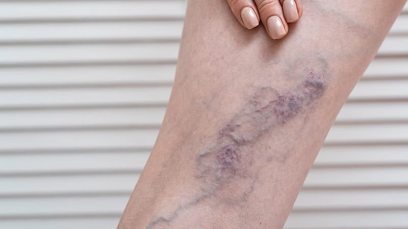 thrombosis Deep vein thrombosis