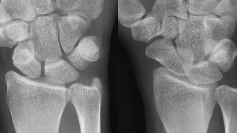 dequervain-tenosynovitis De Quervain's tenosynovitis x-ray