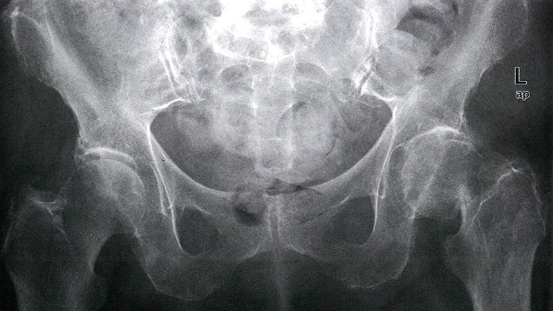 femoral-fracture Femoral fracture X-ray