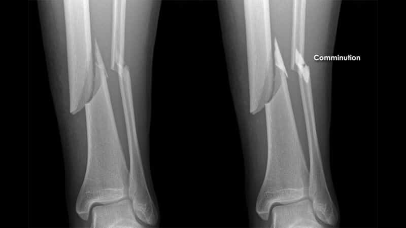 fibular-fracture Fibular fracture X-ray