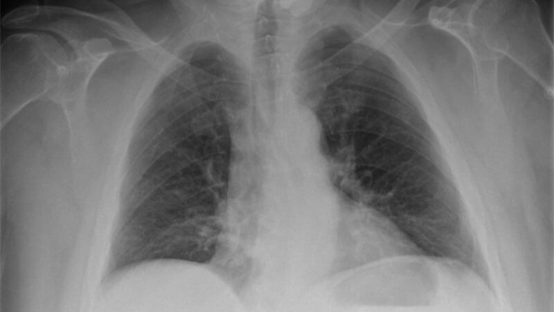 sternal-fracture-xray Sternal Fracture X-ray